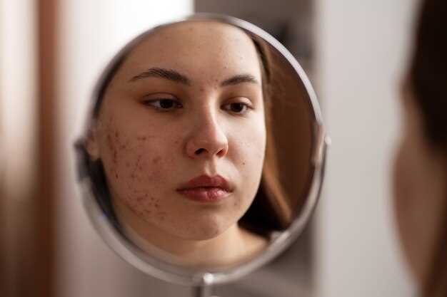 Clearing Acne with Spironolactone