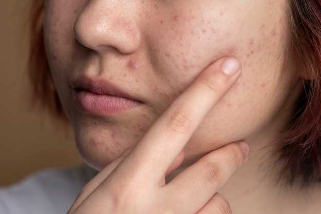 Doryx: A Popular Acne Treatment