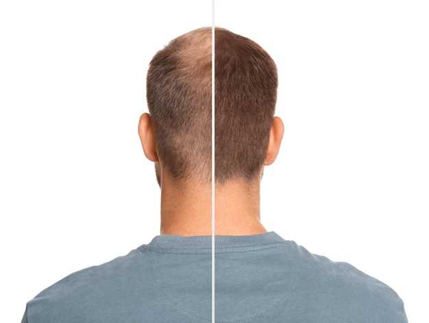 Benefits of Using Spironolactone for Hair Loss