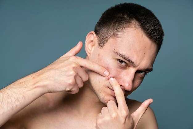 Effectiveness in Treating Male Acne