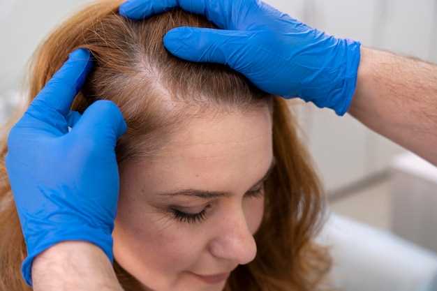 Aldactone spironolactone hair loss