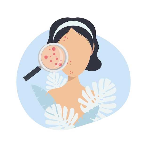 Effect of spironolactone on acne