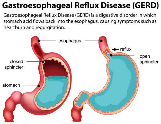 Lasix to spironolactone ratio in cirrhosis