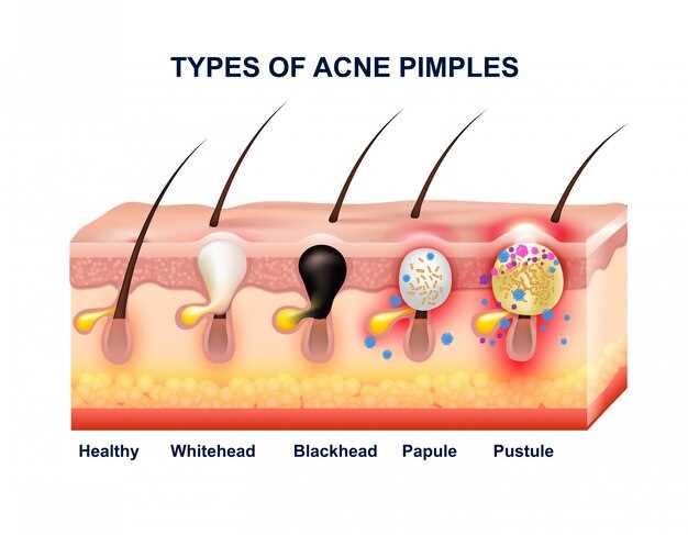 Ortho tri cyclen lo and spironolactone for acne