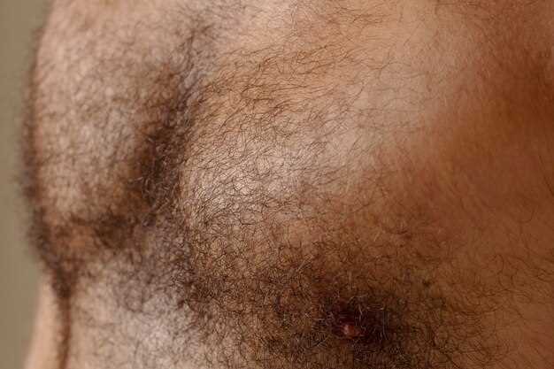 Spironolactone and ingrown hairs