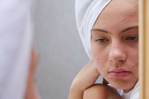 Spironolactone for acne scars