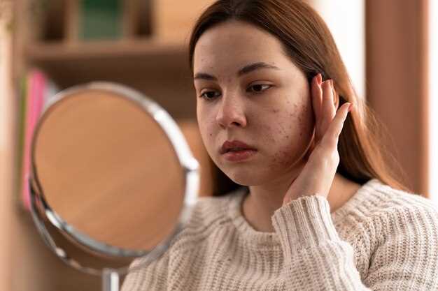 Spironolactone in the treatment of acne
