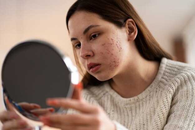 Spironolactone worse acne